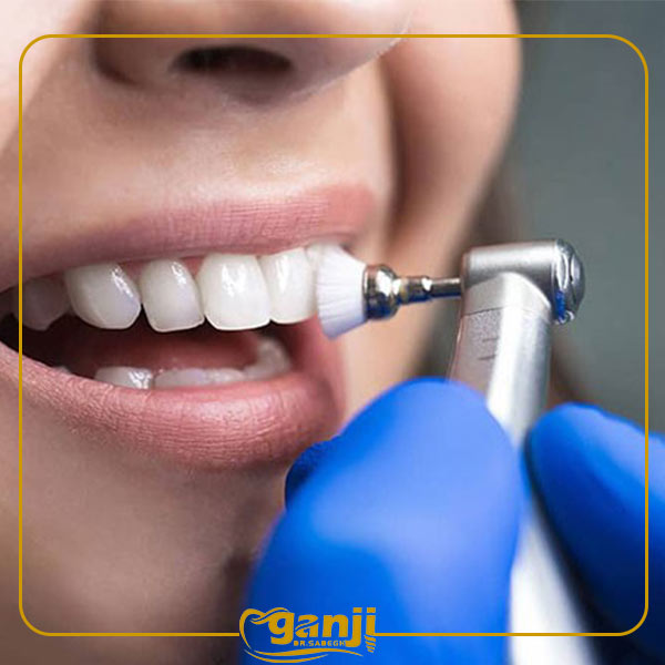 What is tooth polishing? What are the golden tips of 2024 tooth polishing?